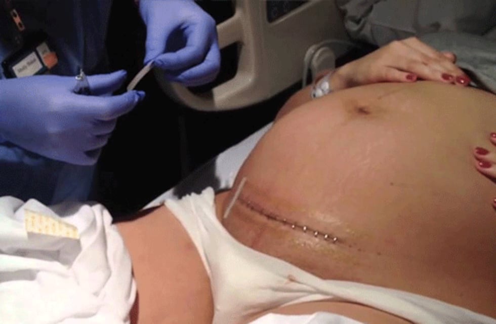 La cantidad de cesáreas que se realizan superan considerablemente los máximos recomendados.&nbsp;