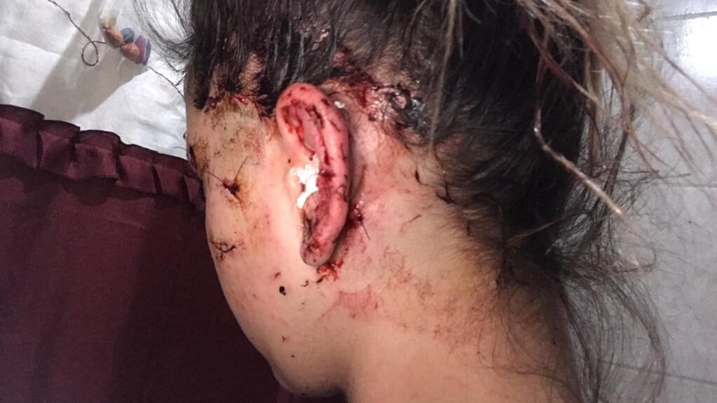 Así quedó la moza atacada en la calle Arístides de la Ciudad de Mendoza (Facebook)