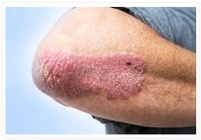 El tratamiento de la psoriasis varía según la gravedad de la enfermedad.