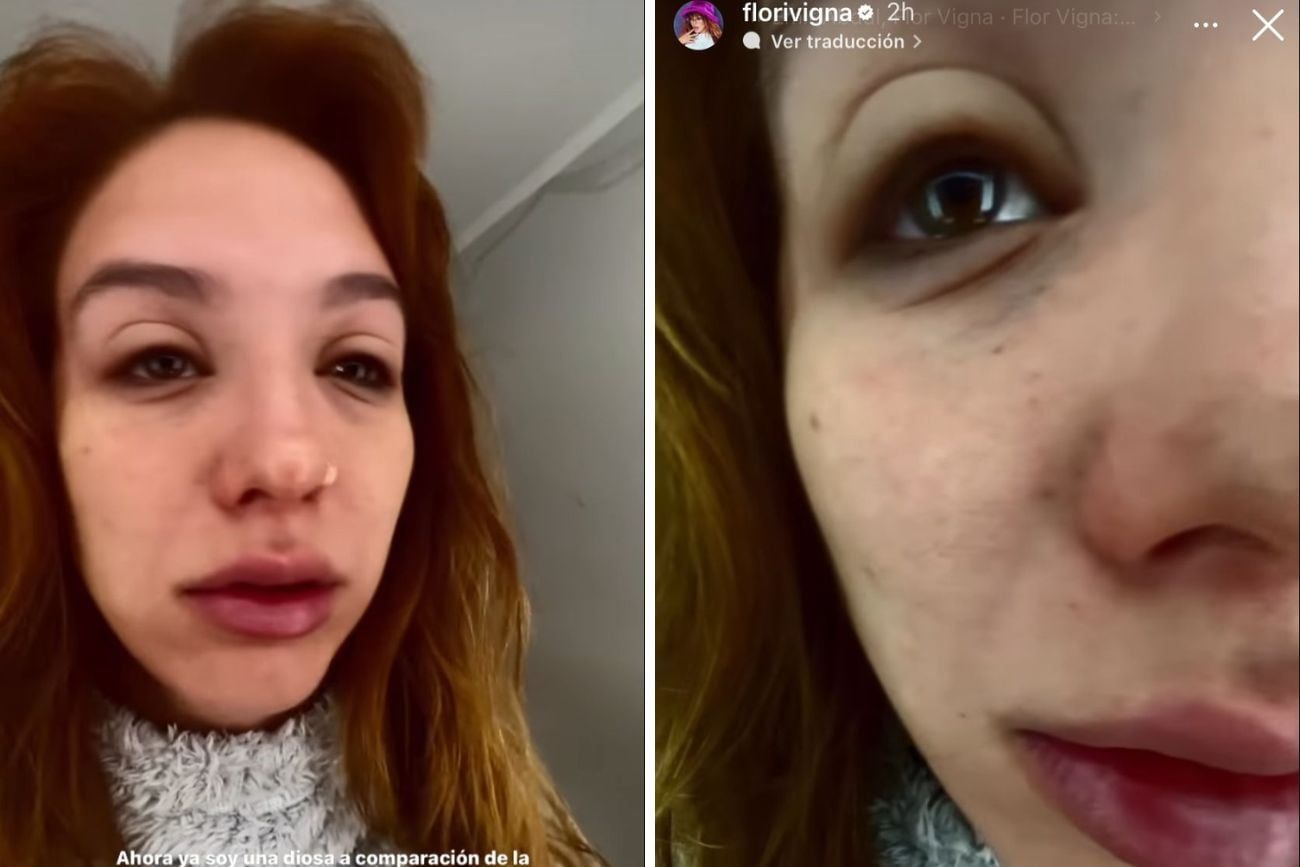 Flor Vigna preocupó al lucir irreconocible a causa de una alergia.