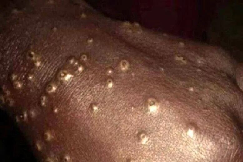 Efectos: ampollas y lesiones en la piel de los pescadores de Senegal - Web