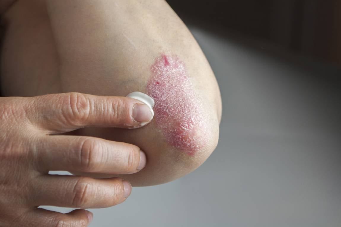 Es importante destacar que la psoriasis es una enfermedad crónica y no tiene cura definitiva. Sin embargo, con un manejo adecuado y un tratamiento personalizado, es posible controlar los síntomas.