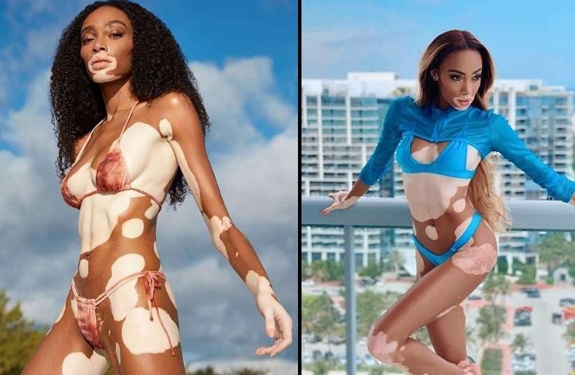 Winnie Harlow modelo con vitiligo