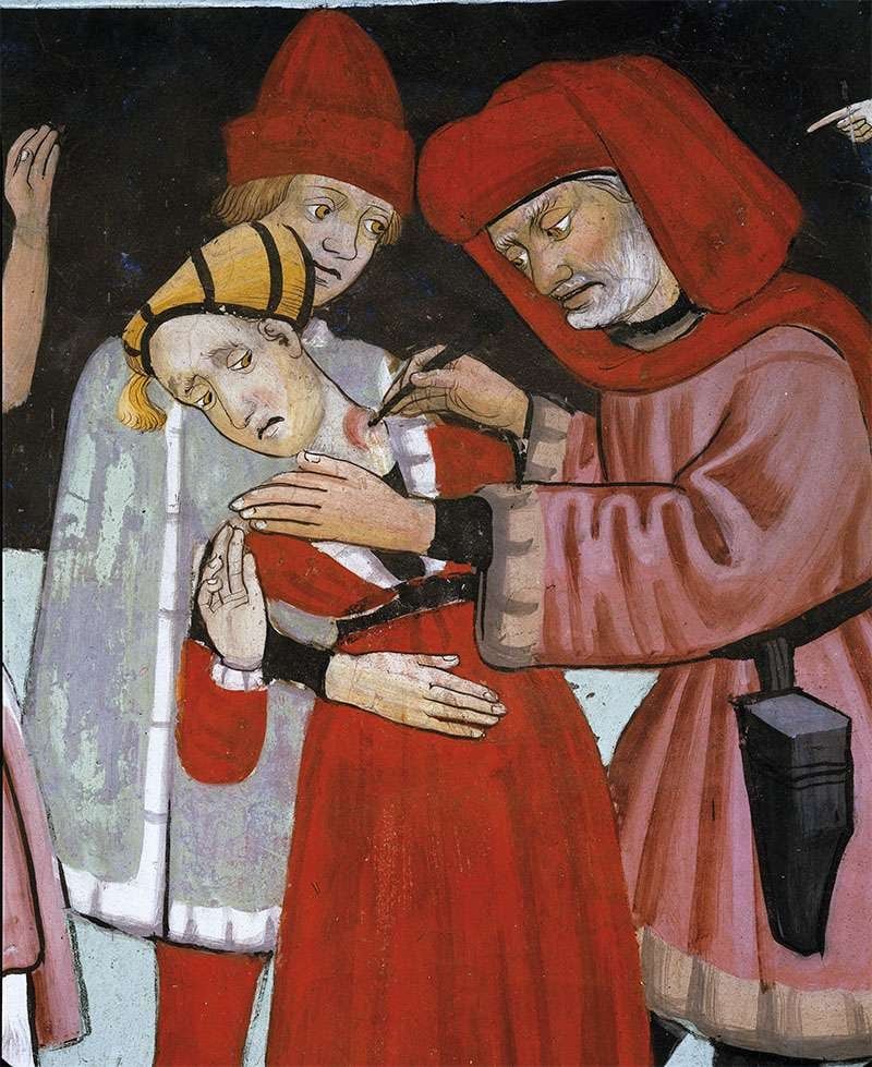 
Los bubones aparecían en las ingles, las axilas y bajo las orejas.
