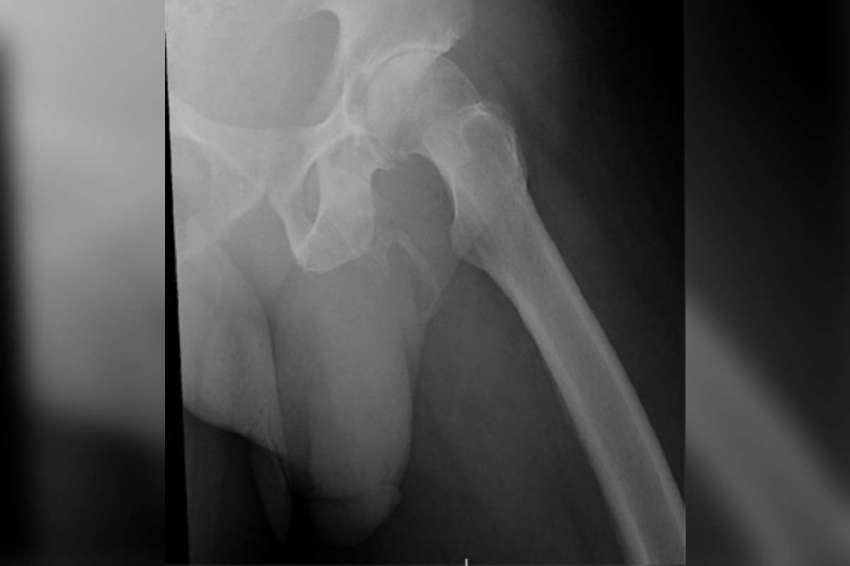 Hay menos de 40 casos reportados en todo el mundo. | / Urology Case Reports