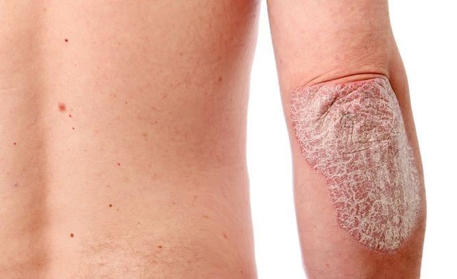 La psoriasis es una enfermedad crónica de la piel que se caracteriza por la aparición de parches rojos, elevados y escamosos en diferentes áreas del cuerpo.