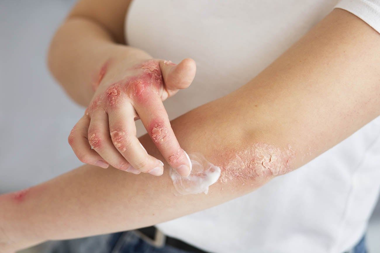 La psoriasis se caracteriza por comprometer la piel, uñas, articulaciones y diferentes órganos del cuerpo.