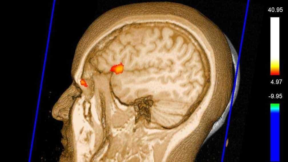 ACV: el tipo más frecuente es el ataque cerebral isquémico (un 88% de los casos aproximadamente), generalmente causado por un coágulo sanguíneo que bloquea o tapa un vaso sanguíneo en el cerebro. En contraposición existe el hemorrágico, que ocurre cuando un vaso sanguíneo en el cerebro gotea o se rompe.
