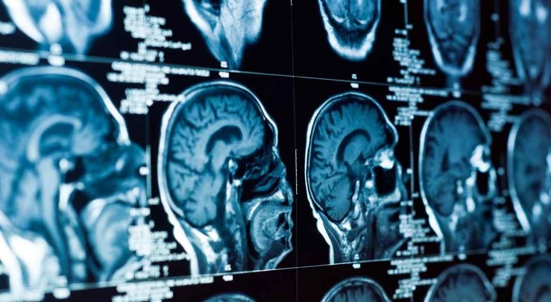 La nueva evidencia sugiere que las personas infectadas por Covid-19 pueden presentar pérdida de memoria, accidentes cerebrovasculares y confusión.