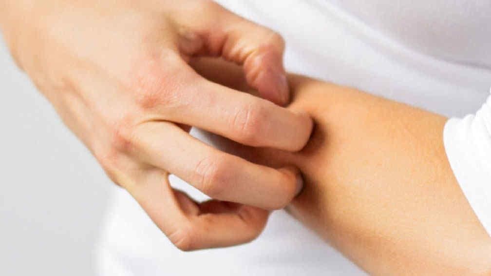 Las lesiones psoriásicas pueden causar picazón intensa y sensación de ardor.