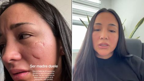 Ser madre duele la declaración de una mujer luego de que su hijo le mordiera el rostro.&nbsp; &nbsp;