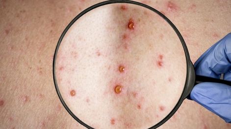 Los Andes | La viruela símica (mpox) es una enfermedad vírica causada por el virus de la mpox, que pertenece al género de los Orthopoxvirus, tal cual describe la Organización Mundial de la Salud (OMS).