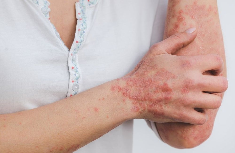 Psoriasis: la importancia de diagnosticar y tratar a tiempo