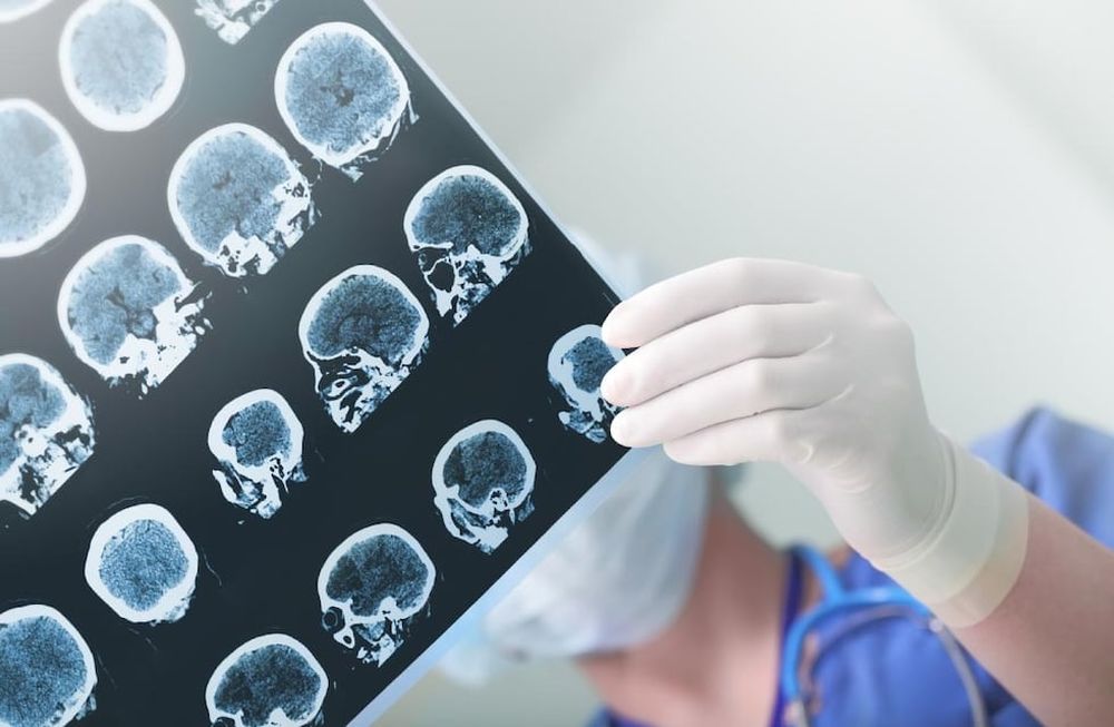 Se presentan más ACV en personas jóvenes y 20% queda con discapacidad. Se considera así a los menores de 45 años pero hay casos que pueden darse incluso a los 30 o menos. Foto: Sanatorio Allende