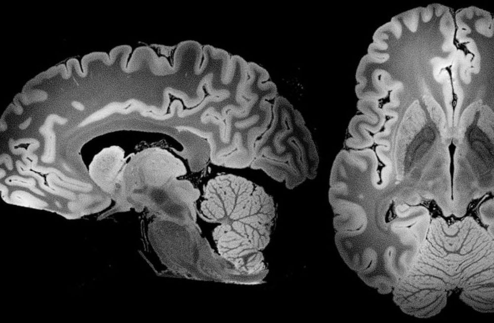 En comparación con muestras de 2016, las de 2024 contenían un 50% más de partículas, sumando aproximadamente 4,800 microgramos de microplásticos por gramo de tejido cerebral.