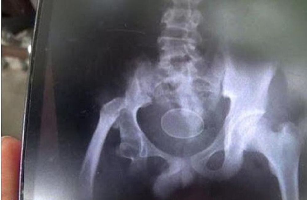 El perturbador caso del chico de 14 años que pone huevos como una gallina