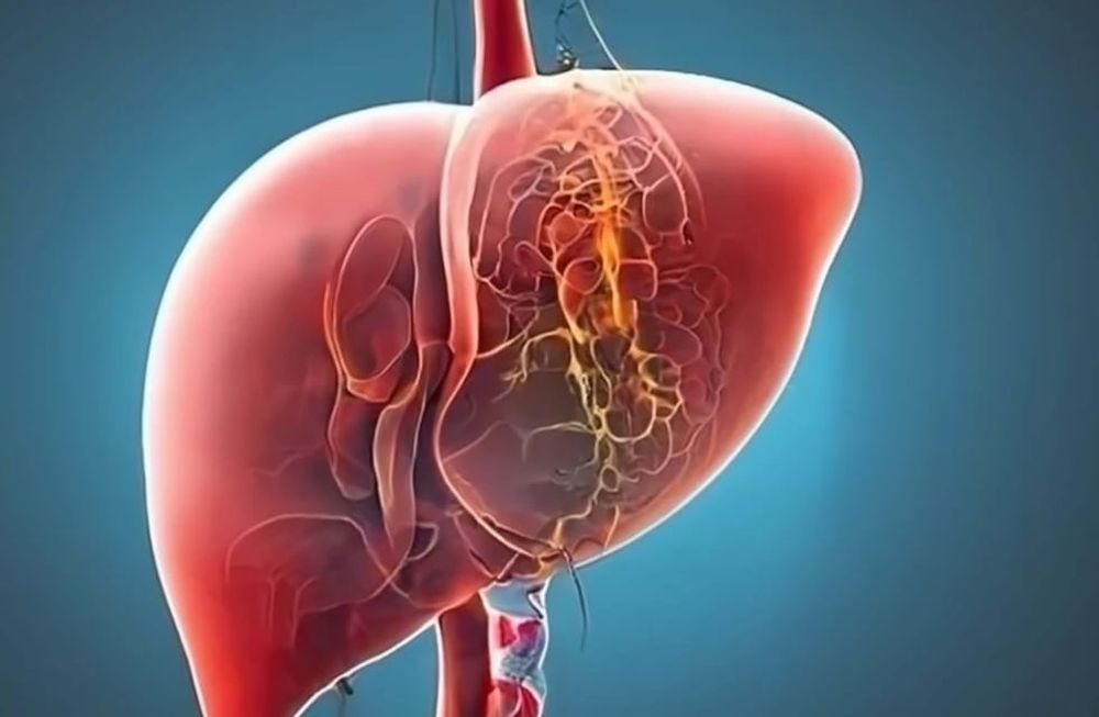 La enfermedad grasa del hígado, actualmente denominada esteatosis hepática es una epidemia oculta.