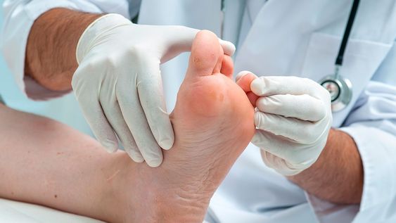 ¿Tenés diabetes? Descubre cómo proteger tus pies con estos 8 consejos clave