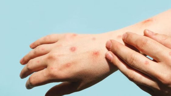 La mpox (antes llamada viruela símica o viruela del mono) es una enfermedad viral infecciosa causada por un ortopoxvirus.