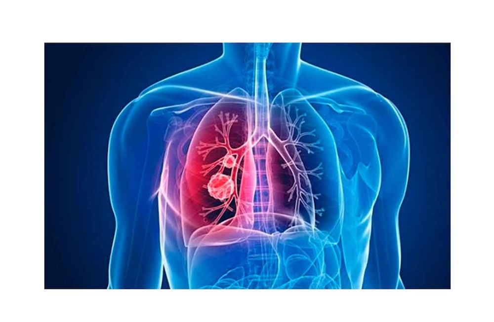 Hipertensión pulmonar: dentro de las 7.000 enfermedades raras en el mundo