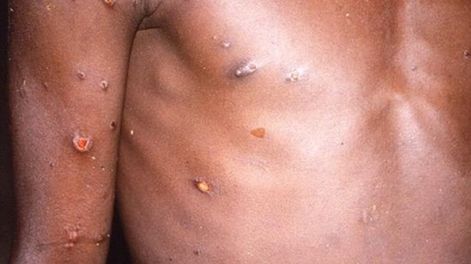 Los Andes | Bélgica es el primer país europeo en imponer cuarentena a los pacientes con diagnósitco confirmado. Foto: BBC.