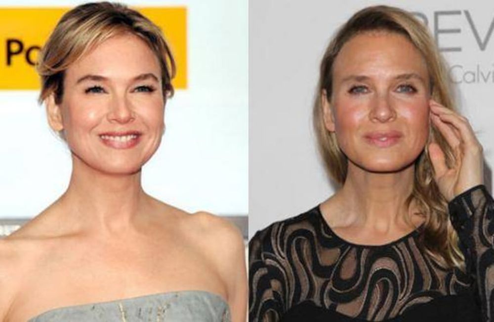 Así quedó Renée Zellweger después de una catarata de cirugías