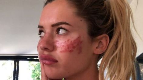 Los Andes | La modelo Tilly Whitfeld se provocó lesiones irreparables en la cara.