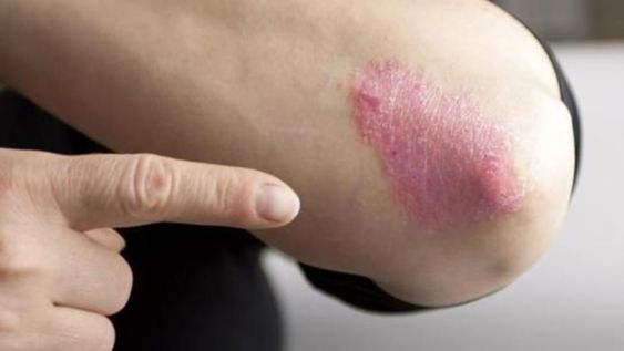 Psoriasis: educación y nuevos tratamientos, el camino para el  control de la enfermedad