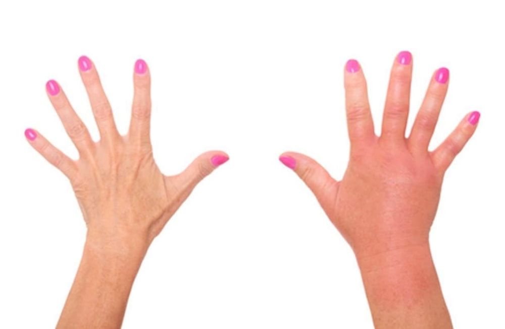 Hinchazones o edemas: ¿son siempre causa alérgica?