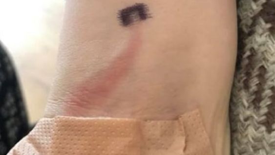 Notó que su hijo tenía una rara marca roja en el brazo y le salvó la vida sin saberlo