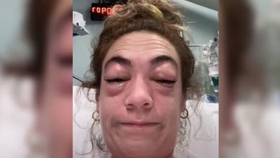 Una tiktoker mostró la reacción alérgica que tuvo tras ponerse una extensión de pestañas.