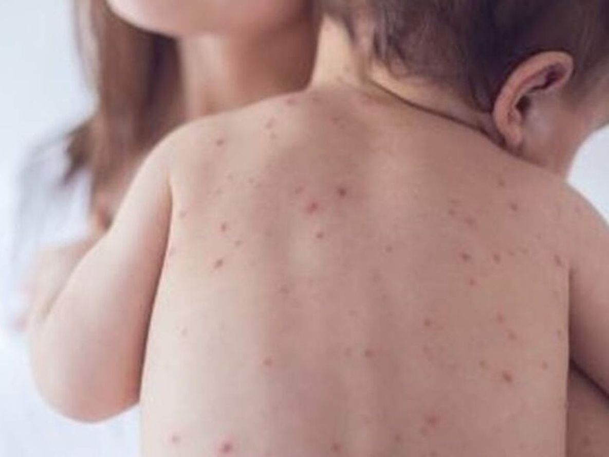 El sarampión es una enfermedad viral, altamente contagiosa, que puede presentarse en todas las edades.