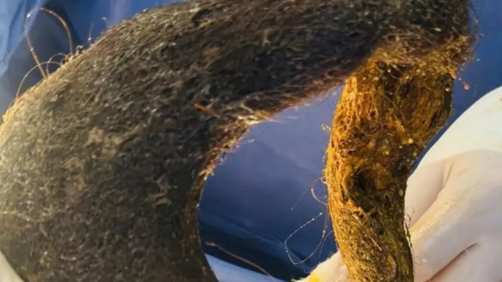 Sufrió dolor de estómago durante 6 meses y descubrieron que tenía una bola de pelo gigante