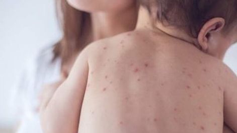 El sarampión es una enfermedad viral, altamente contagiosa, que puede presentarse en todas las edades, siendo de mayor gravedad en niños menores de 5 años o desnutridos, en los cuales puede causar graves complicaciones respiratorias 