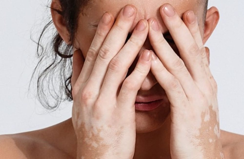 Vitiligo, más que solo manchas