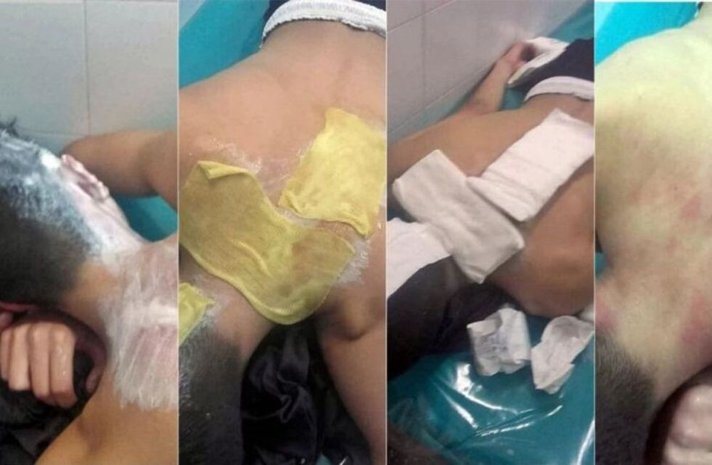 En La Pampa un hincha quemó con agua caliente a un futbolista de 15 años