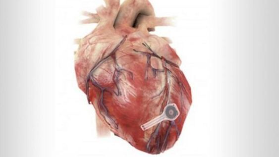 El nuevo marcapaso es biodegradable y no necesita intervención quirúrgica para su colocación. además se disuelve cuando el corazón ya no lo necesita.