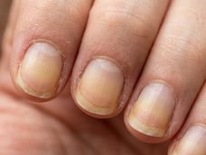 unas amarillas: por que aparecen, cuales son las senales a las que debes prestar atencion y cuando conviene consultar a un dermatologo