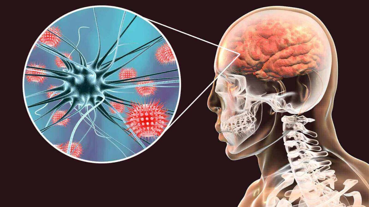 Alerta en Argentina: los casos de meningitis superan la media esperada en 2026