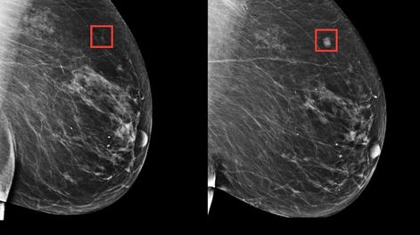 Se trata de una serie de algoritmos que aprenden los sutiles patrones del tejido mamario que son precursores de un tumor maligno. Foto: Massachusetts General Hospital.