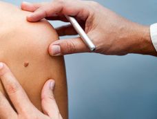 Melanoma, el cáncer de piel más agresivo