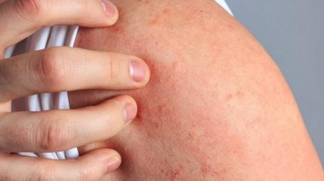 Dermatitis atópica: una afección común que padecen entre el 15% y el 30% de los niños