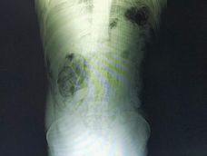 Una radiografía muestra la droga en el cuerpo de uno de los detenidos. Gentileza Gendarmería Nacional.&nbsp;