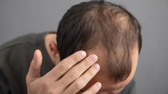 No existe un truco definitivo pero hay diferentes formas de anticiparse a la caída constante del pelo.