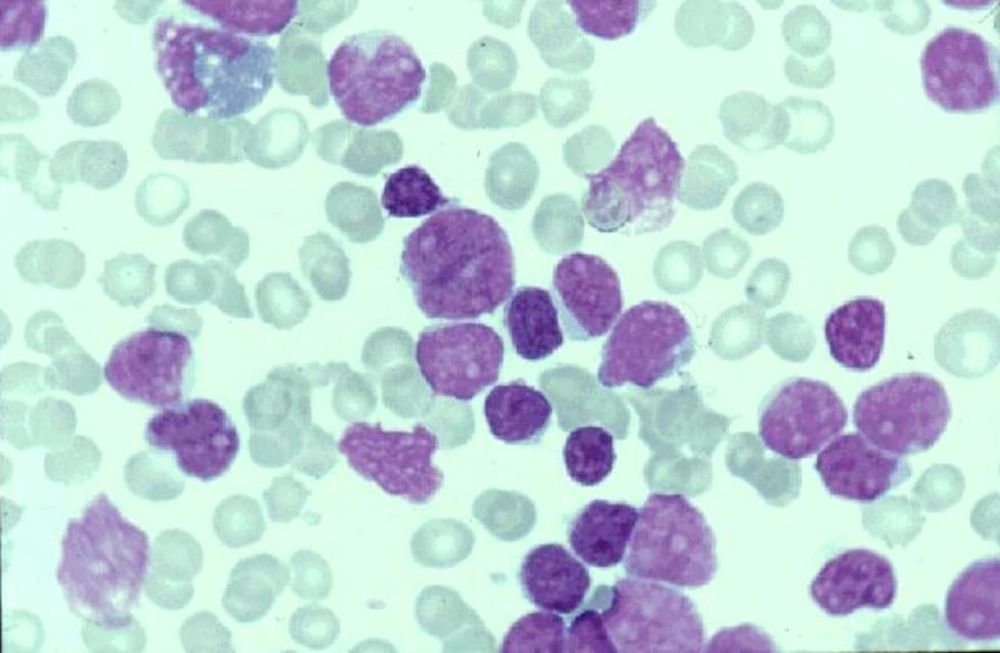 Es urgente visibilizar cánceres hematológicos y promover diagnósticos más oportunos