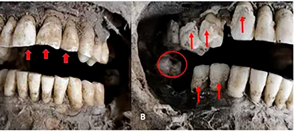 Radiografía de contacto del pulmón derecho extirpado. Esta confirmó las calcificaciones focales (flechas rojas) y el quiste con márgenes capsulares (círculo rojo).