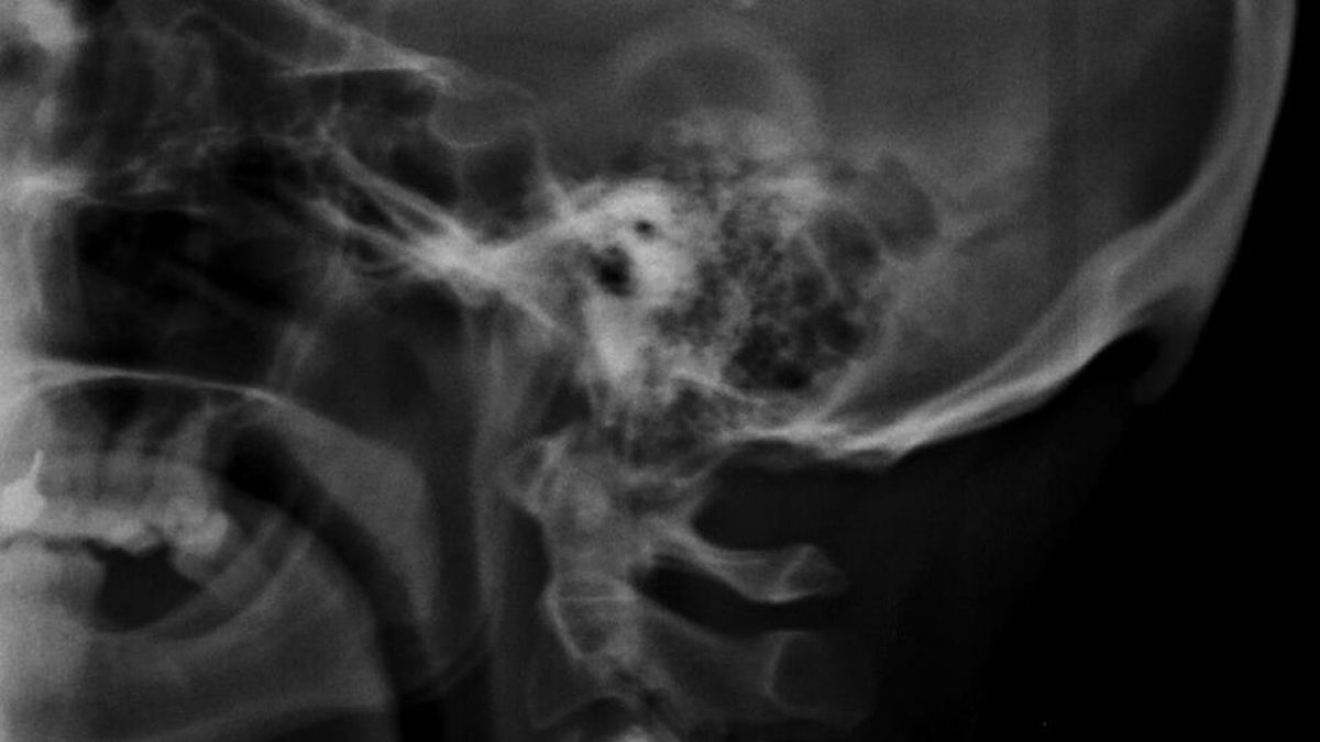 El celular provoca la aparición de un raro hueso en el cráneo: cómo ...