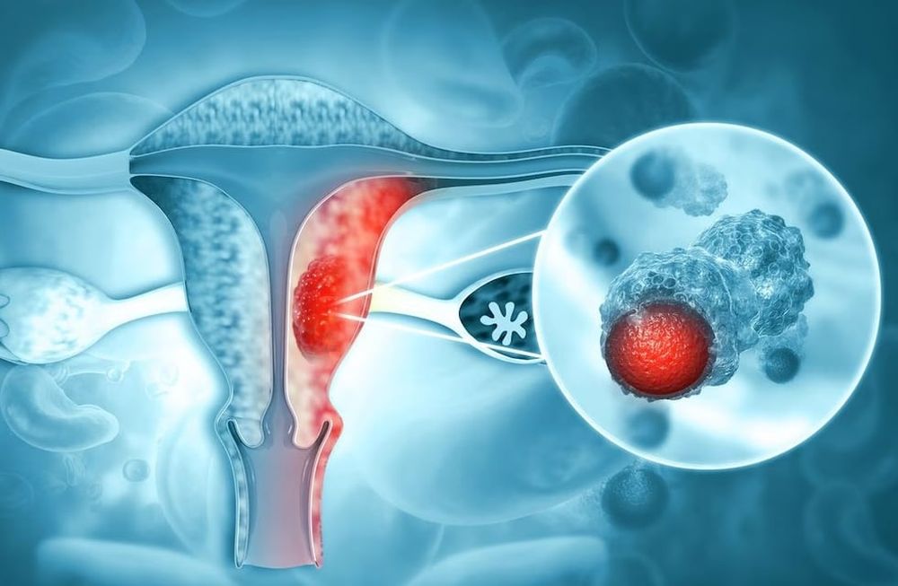 ¿Cómo se usa la Biología Molecular para detectar el VPH, el virus que causa cáncer de cuello de útero?