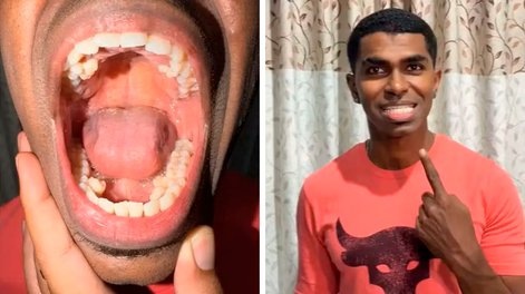 Prathab Muniandy y su boca con 42 dientes.