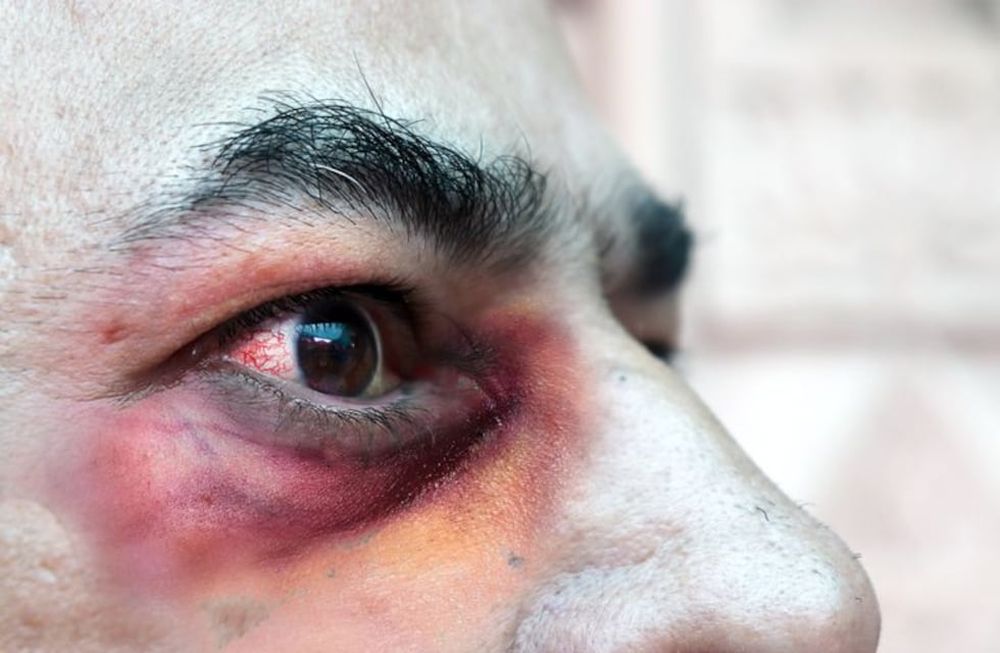 Nuestro país reportó la primera muerte producto de la murcomicosis, la infección conocida en el mundo como “hongo negro”. Foto: Gentileza